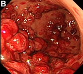 Bağırsak Kanaması Belirtileri ve Tedavisi Bağırsak Kanaması Belirtileri ve Tedavisi