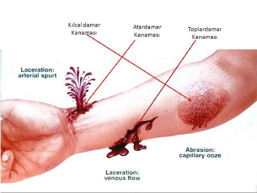 Atardamar Kanaması Belirtileri ve Tedavisi