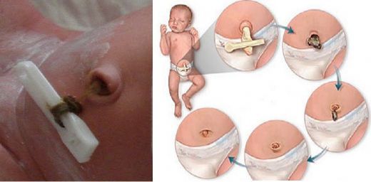 Bebeklerde Göbek Kanaması Belirtileri ve Tedavisi