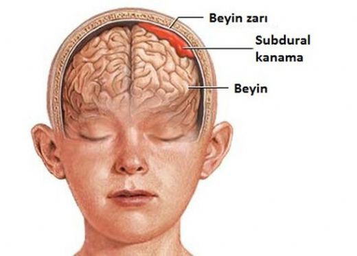 Beyin Kanaması Kaç Gün Sürer?