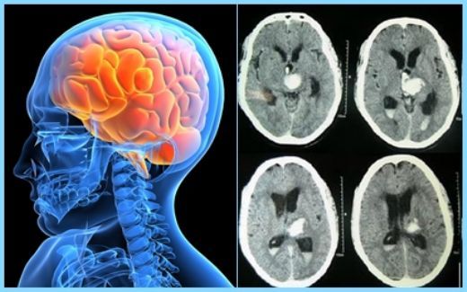 Beyin Kanaması Sonrası