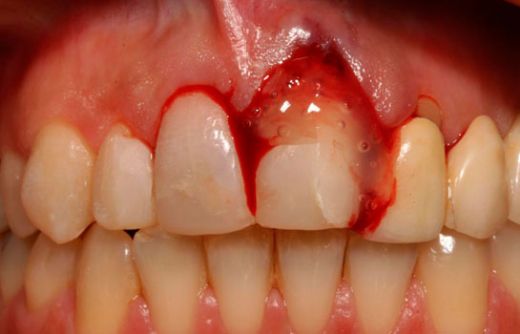 Diş Eti Kanaması Neden Olur?