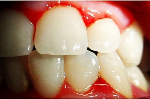 Gece Diş Eti Kanaması Belirtileri ve Tedavisi