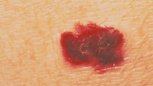 Kırmızı Ben Kanaması Tedavisi