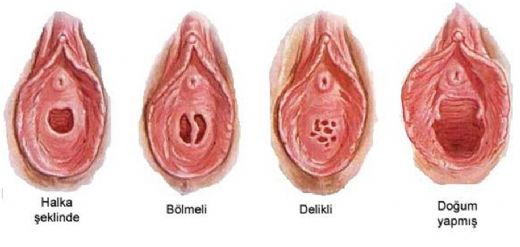 Kızlık Kanaması Nedir?