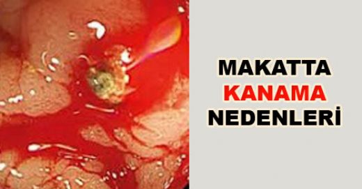 Makatta Kanama Belirtileri ve Tedavisi