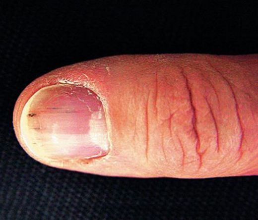 Siyah Kanama Belirtileri ve Tedavisi