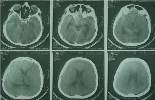 Subaraknoid Kanama Belirtileri ve Tedavisi