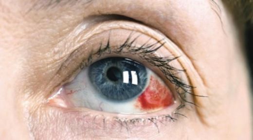 Subkonjonktival Kanama Belirtileri ve Tedavisi