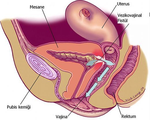 Vajinada Kanama Nedenleri?